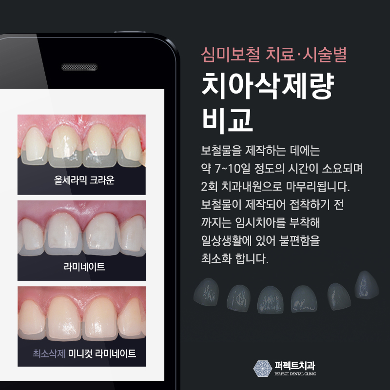 앞니 라미네이트 관련 이미지 3