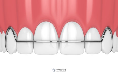 라미네이트 후 치아가 벌어졌어요! 관련 이미지 4