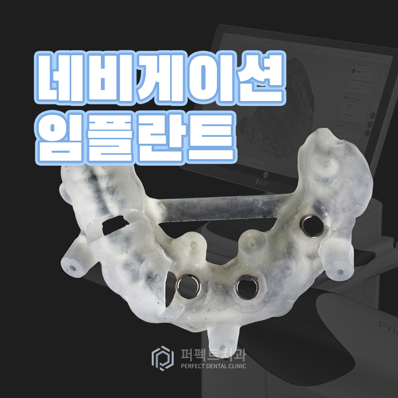 네비게이션 임플란트? 일반 임플란트랑 뭐가 달라?! 관련 이미지 1