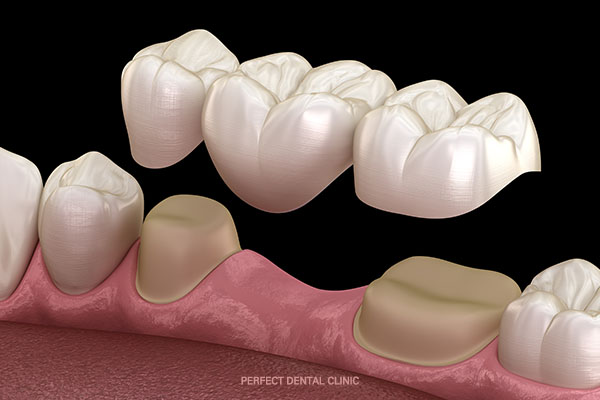 치아가 빠졌다면? 임플란트 vs 브릿지 관련 이미지 1
