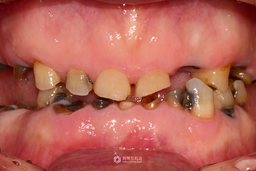 살릴 수 있는 치아가 없다면?❌｜전체임플란트 수복 관련 이미지 3