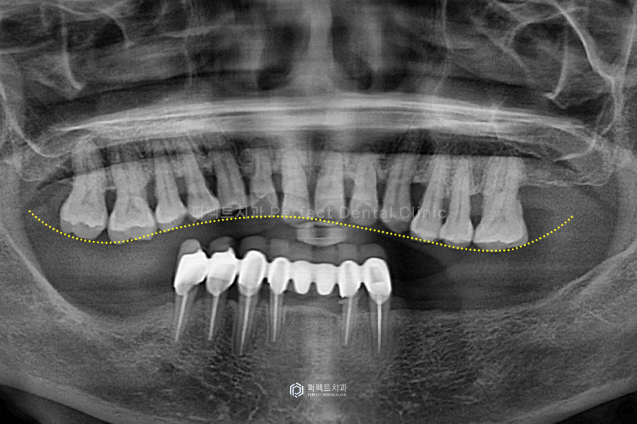 윗니 전체 신경치료 했다고?😱 교합평면이 뭐길래 관련 이미지 3