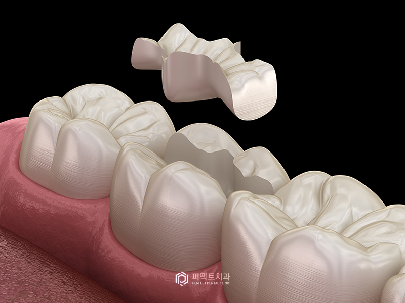 충치치료 인레이, 어떤 경우에? 관련 이미지 4