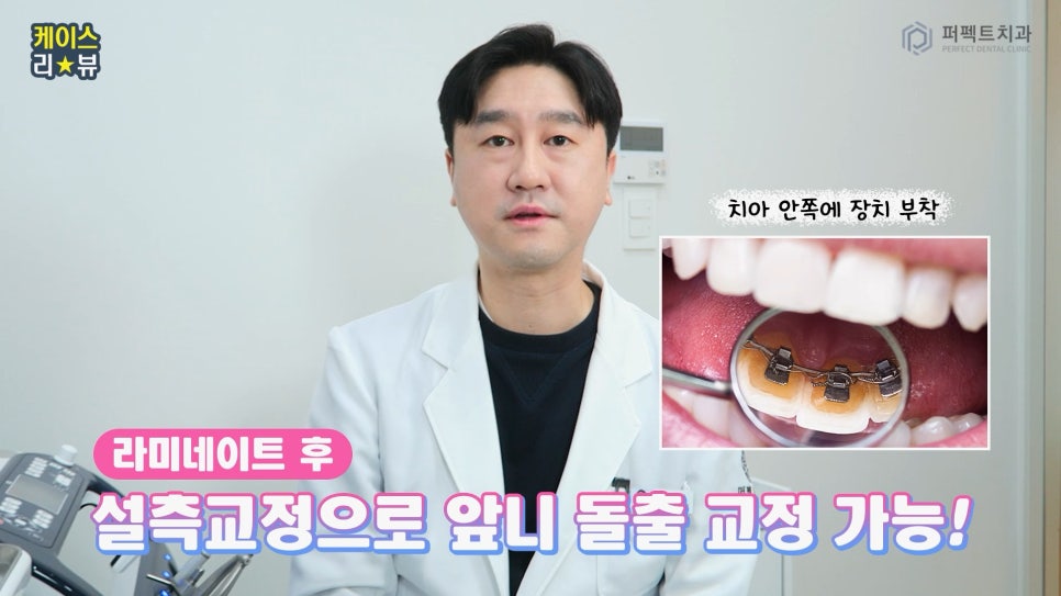 앞니 돌출 있는데 폴리네이트로 극복 가능..?🤔 관련 이미지 8