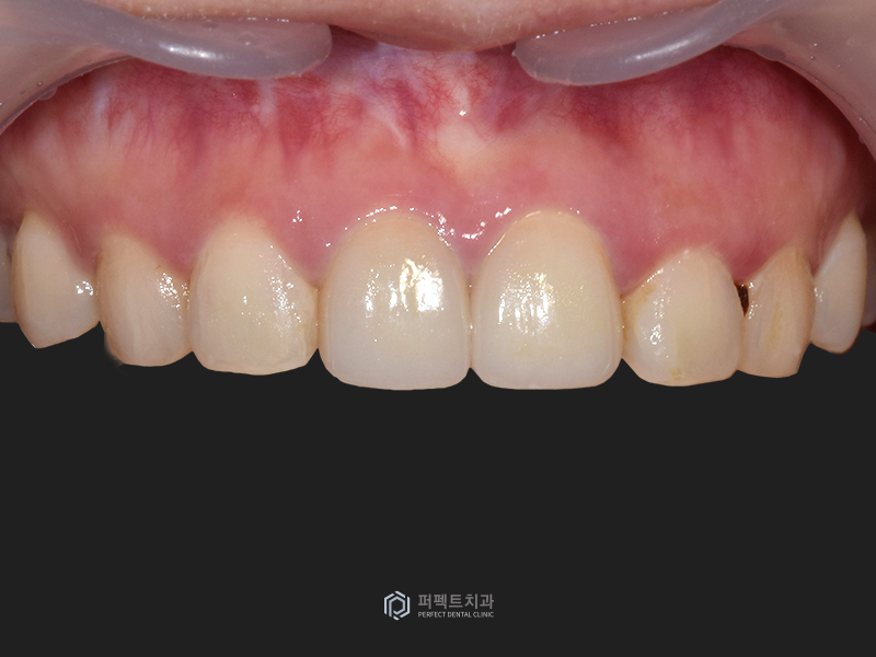 오래된 보철물 교체 및 폴리네이트까지! 관련 이미지 2