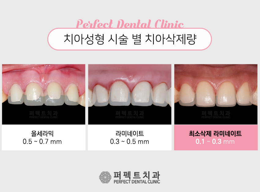 교정 후 왜소치라미네이트 시술! 관련 이미지 6