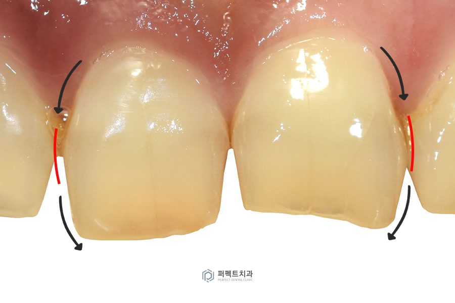 파절+부식된 치아, 크라운이 필요했던 이유는? 관련 이미지 3