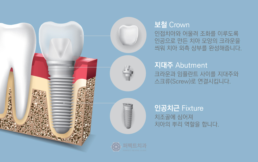 임플란트 시 가장 많이 하는 질문 Best 관련 이미지 2