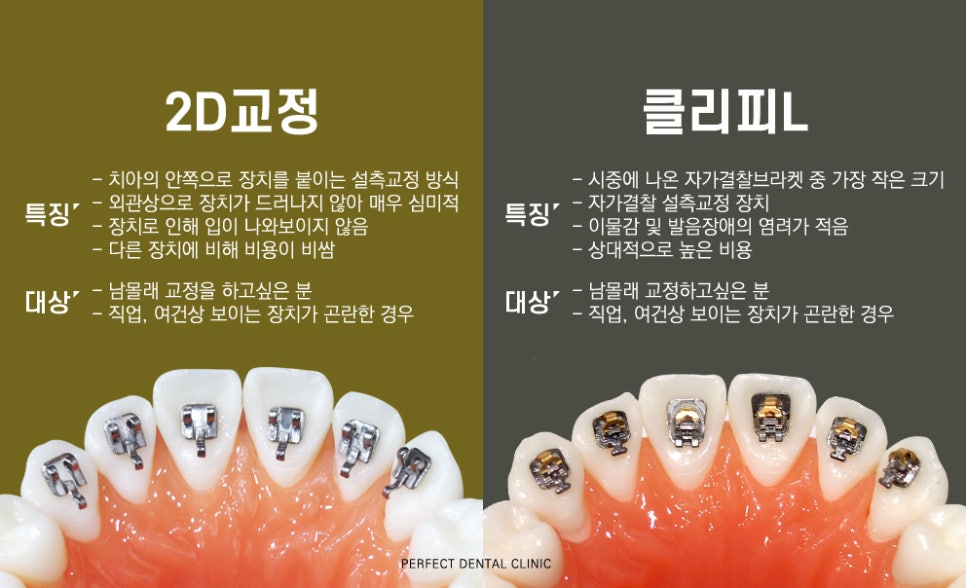 치아안쪽에 부착하는 설측교정! 관련 이미지 3