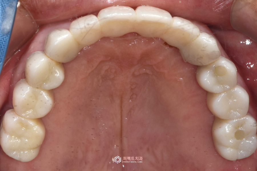 살릴 수 있는 치아가 없다면?❌｜전체임플란트 수복 관련 이미지 10