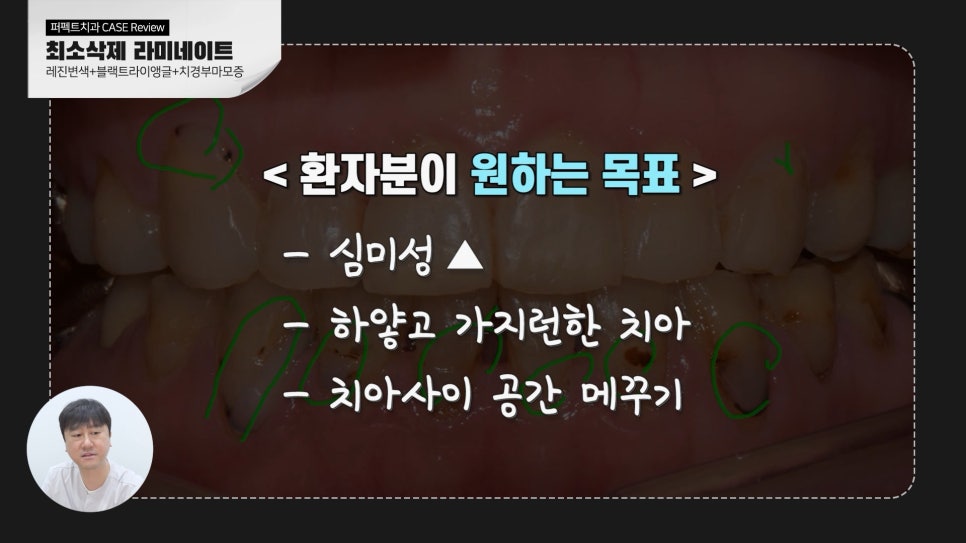 변색된 레진👉라미네이트 교체 관련 이미지 3