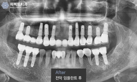 노인 임플란트 건강보험 혜택은? 관련 이미지 2