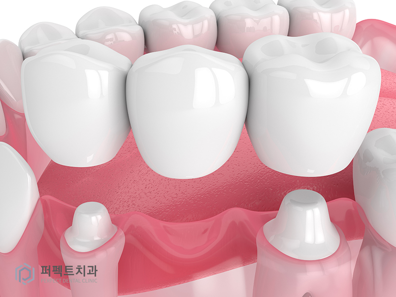 20대도 임플란트가 필요한가요? 관련 이미지 3