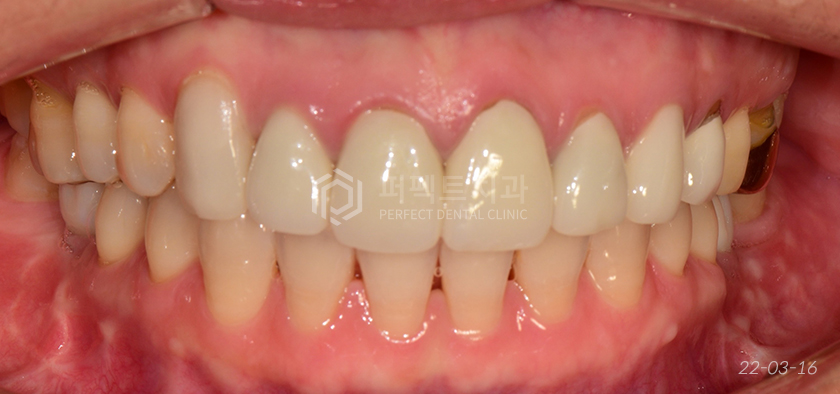 라미네이트를 뜯어보니😨..충격주의 #앞니신경치료 관련 이미지 3