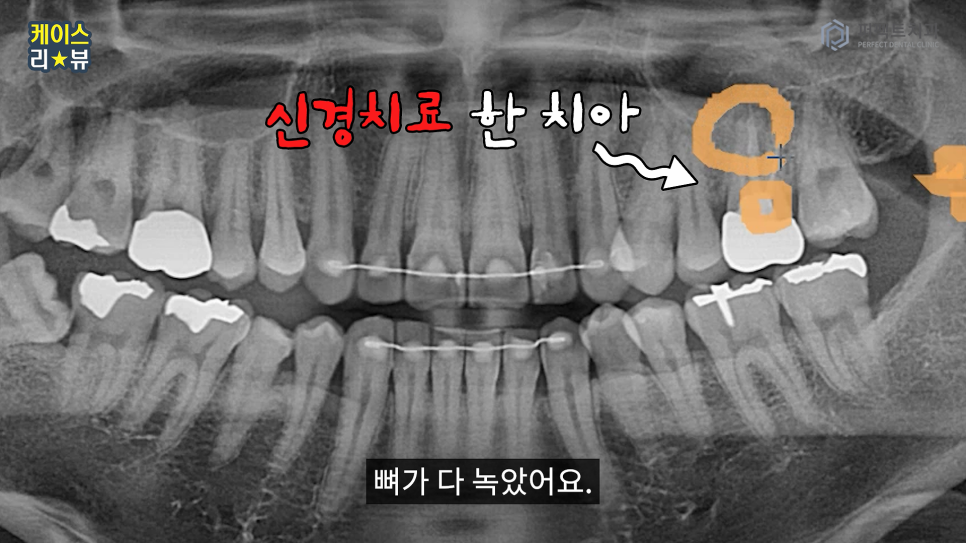 3분만에 임플란트를 할 수 있을까? 가이드임플란트 알아보기 관련 이미지 6