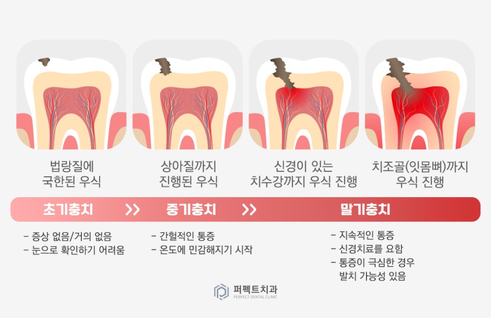 미룰수록 어려운 충치치료, 초기에 치료해요! 관련 이미지 3