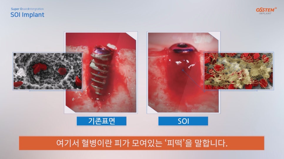 임플란트 종류|좋은 임플란트 고르는 방법은? 관련 이미지 3