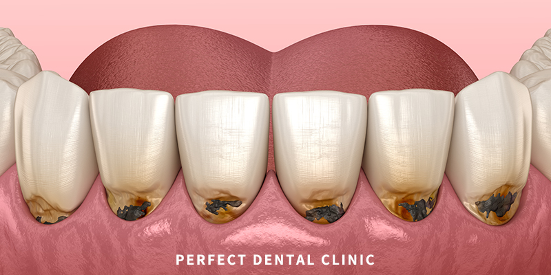 시린 이 치경부 마모증 비용 관련 이미지 2