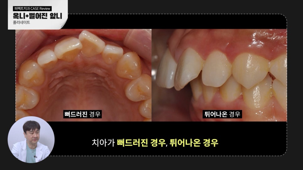 벌어진앞니 무삭제라미네이트 케이스 관련 이미지 4