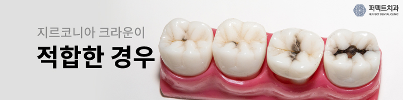 지르코니아 크라운 가격 다른 이유는? 관련 이미지 5