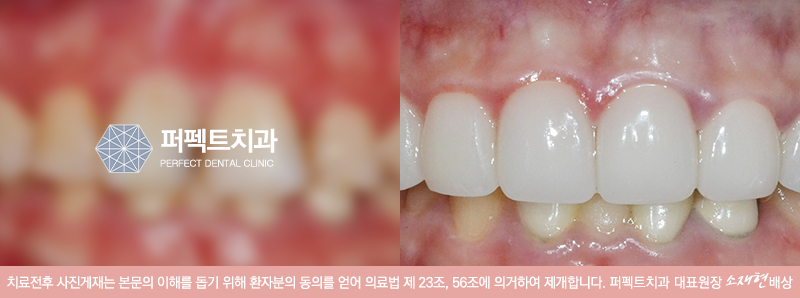 나에게 라미네이트 부작용이 생긴 이유 관련 이미지 3