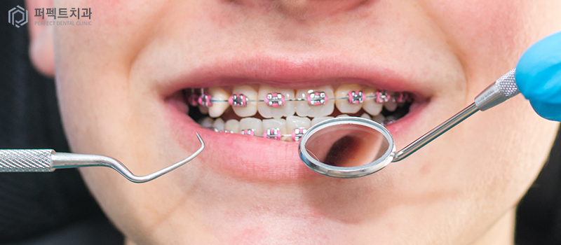 치아교정 중 주의사항 관련 이미지 1