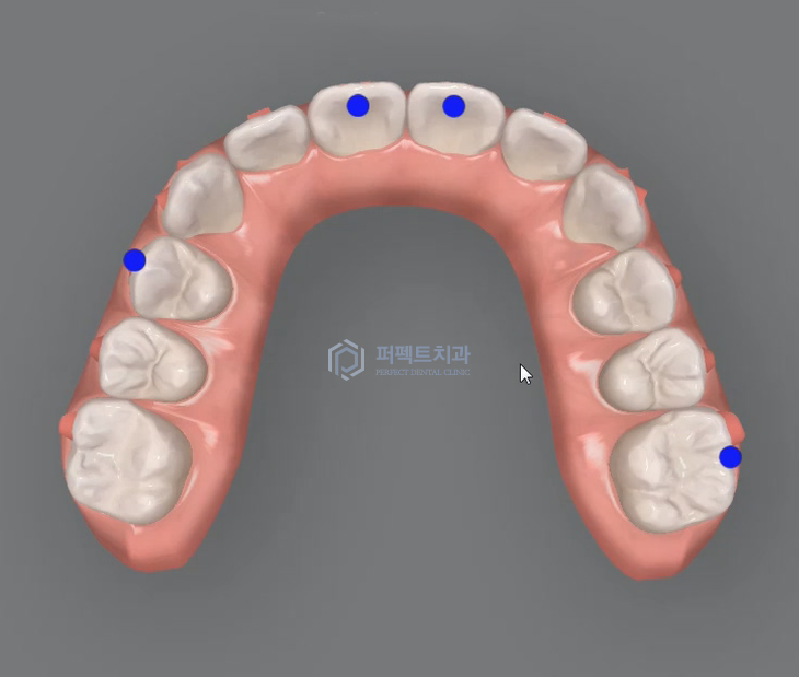 인비절라인 효과 알아보기 (+인비절라인라이트) 관련 이미지 9