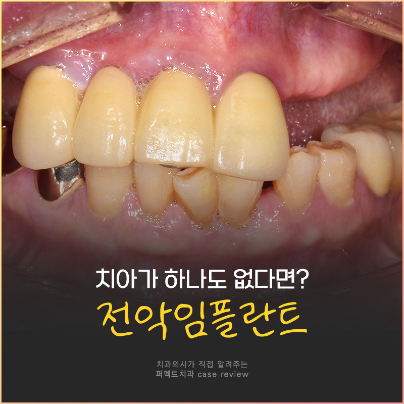 치아가 하나도 없을 때 필요한 전악임플란트😬 관련 이미지 1