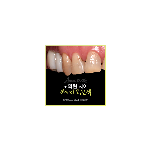 노화된 치아, 최소삭제라미네이트 관련 이미지 6