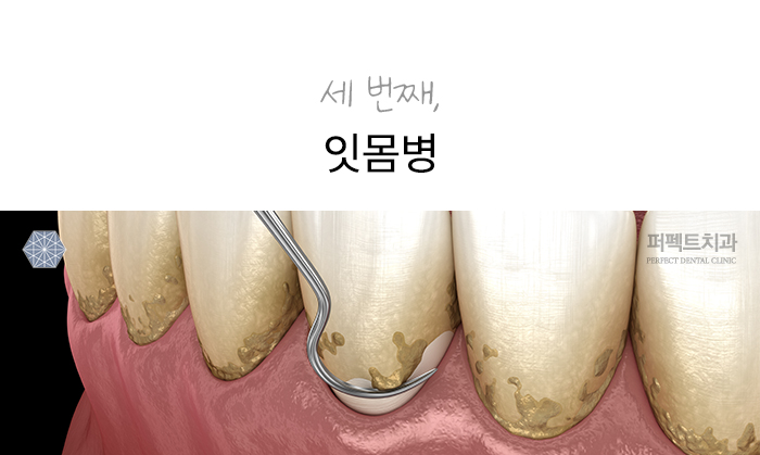 절대 무시하면 안 되는 치아증상 (치과치료꿀TIP!) 관련 이미지 4