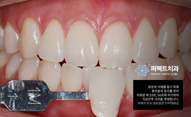 치아미백과정과 치아미백가격 알아보기 관련 이미지 3