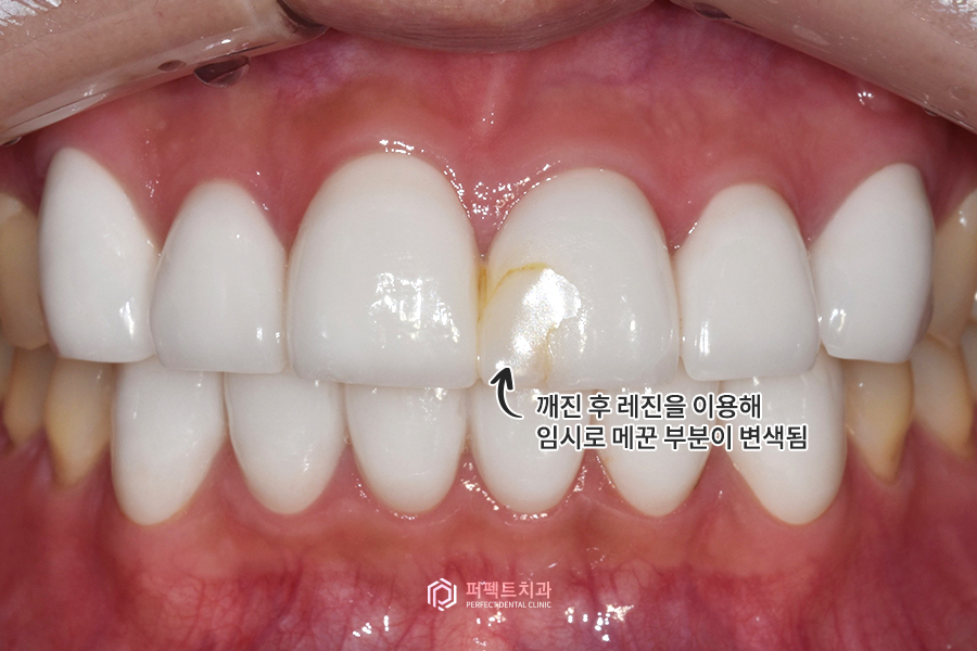 보철치료, 10년 후에는 교체를 해야한다?🤨 관련 이미지 2