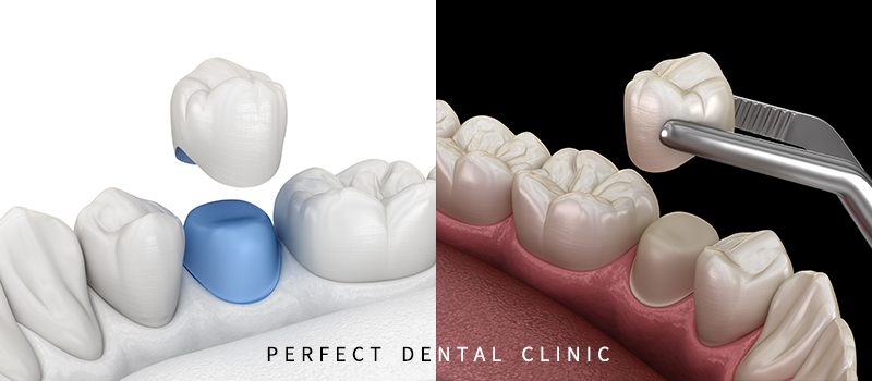 어금니 지르코니아 크라운 가격 관련 이미지 2