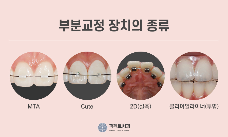 아랫니 부분교정 비용은? 관련 이미지 4