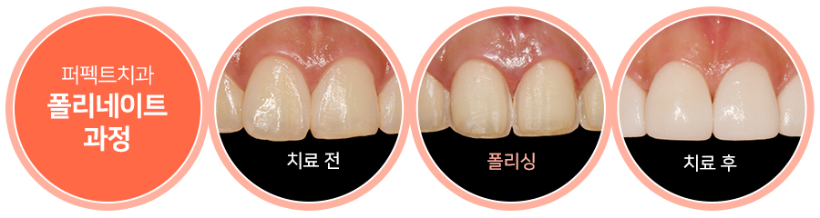 라미네이트 치료 시 참고사항은? 관련 이미지 5