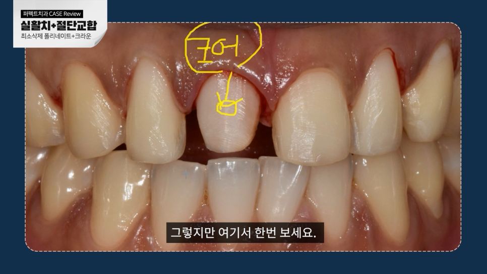 남자라미네이트, 더 오래 사용하려면? 관련 이미지 8