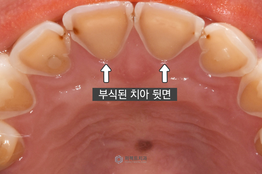 치아부식으로 크라운까지 하게 된 이유는? 관련 이미지 4