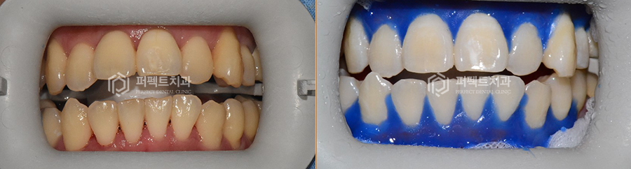 셀프미백보다 전문가미백이 효과적인 이유는? 관련 이미지 5