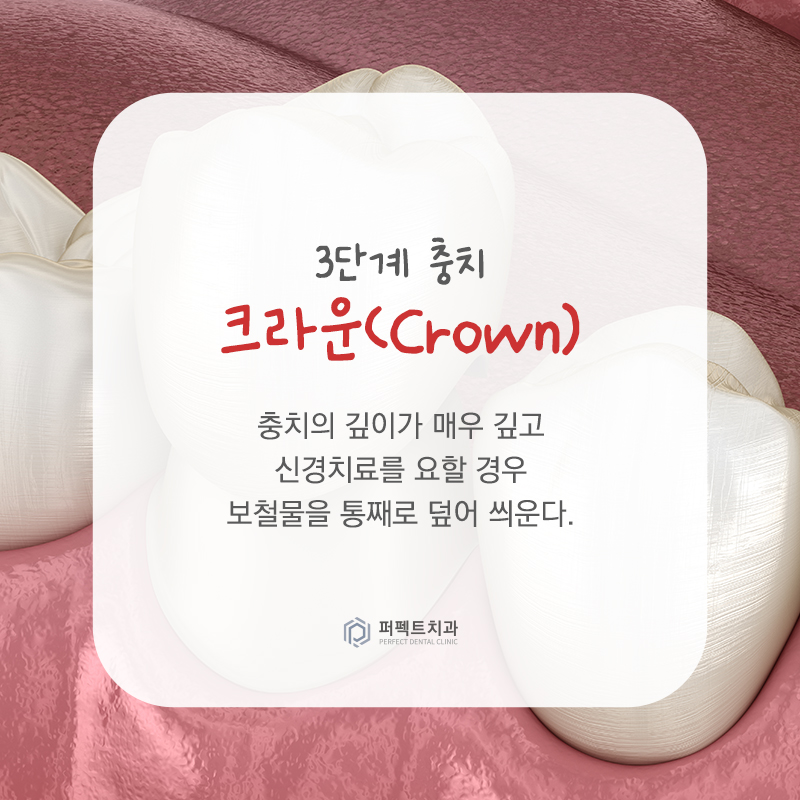 충치치료 단계와 치료방법 알아보기 관련 이미지 5