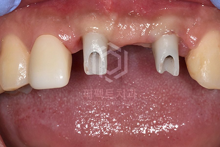 앞니 임플란트 후 잇몸이 까매진다? 관련 이미지 3