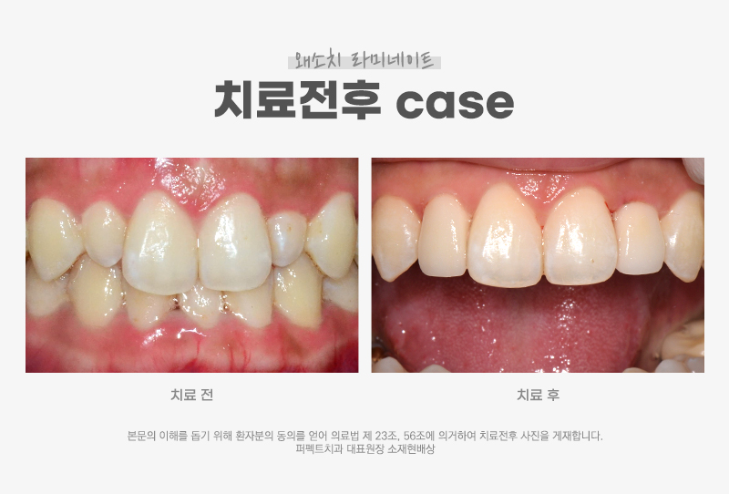 왜소치(작은치아)는 무삭제로 라미네이트 가능한가요? 관련 이미지 3