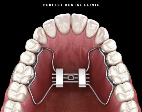 MARPE 악궁확장장치로 위턱 넓히기?! 관련 이미지 1