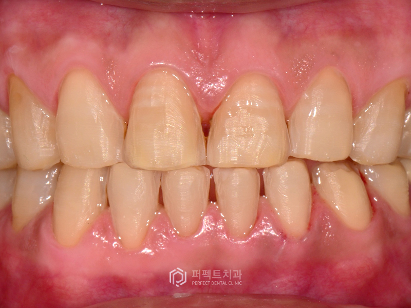 테트라사이클린 치아변색 폴리네이트 케이스 관련 이미지 4