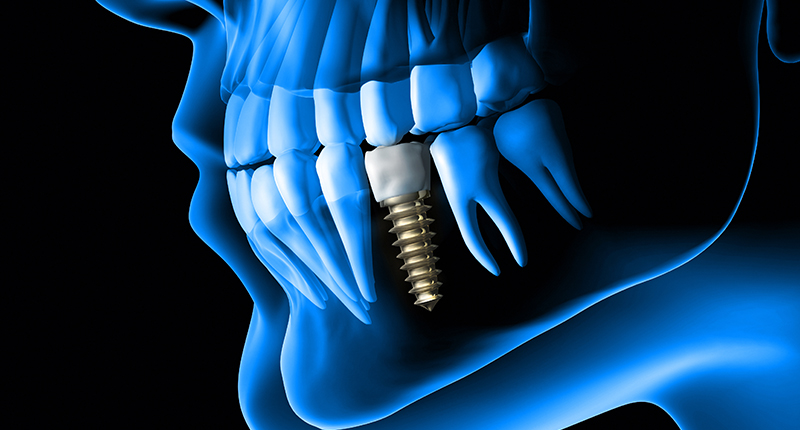 노인 임플란트 건강보험 혜택은? 관련 이미지 4