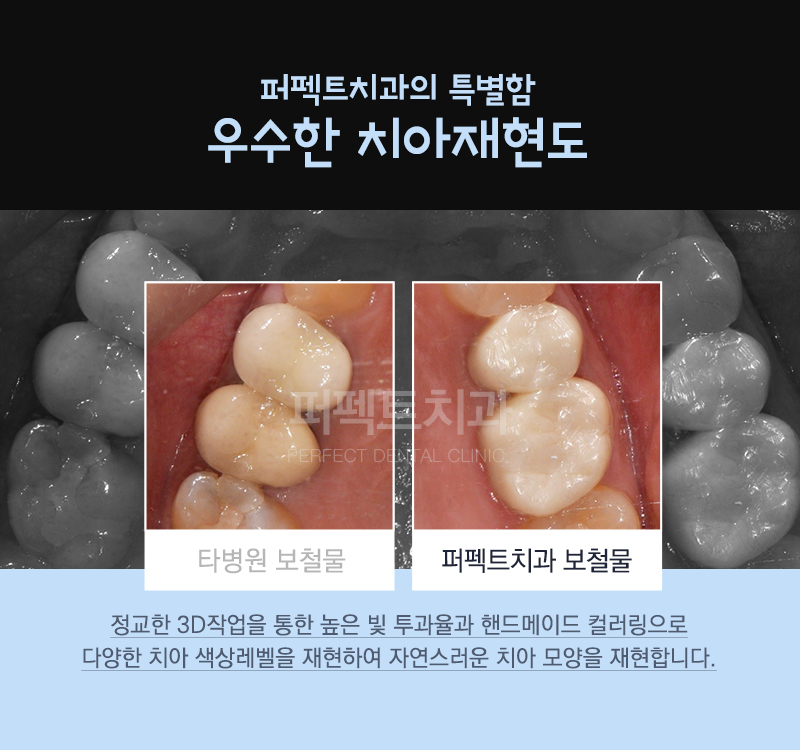 선릉 충치치료 인레이 알아보기! 관련 이미지 10