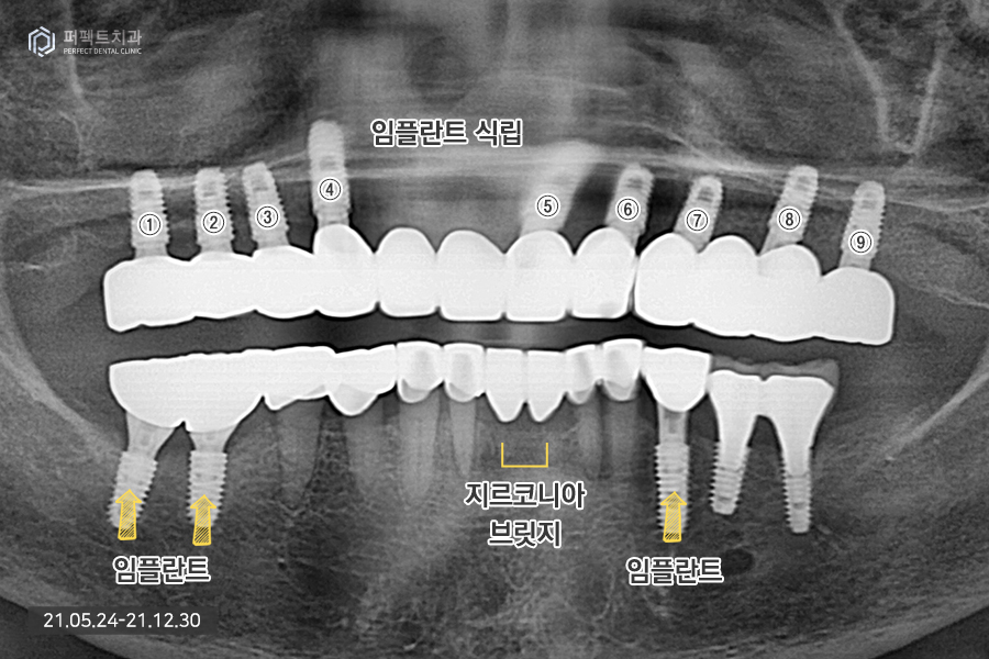 치아가 하나도 없을 때 필요한 전악임플란트😬 관련 이미지 6