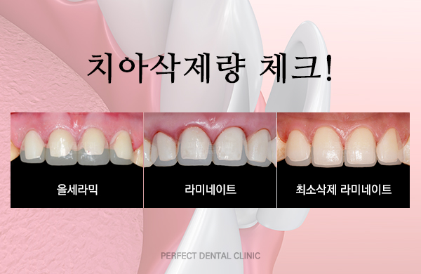 치아성형으로 아름다운 미소를! 관련 이미지 2