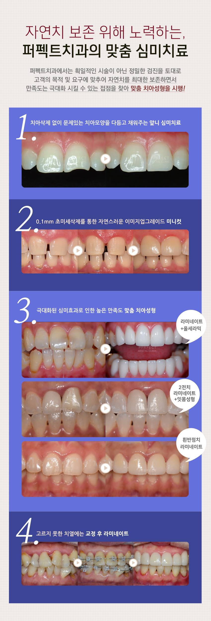 토끼이빨라미네이트 알아보고 있다면?! 관련 이미지 3