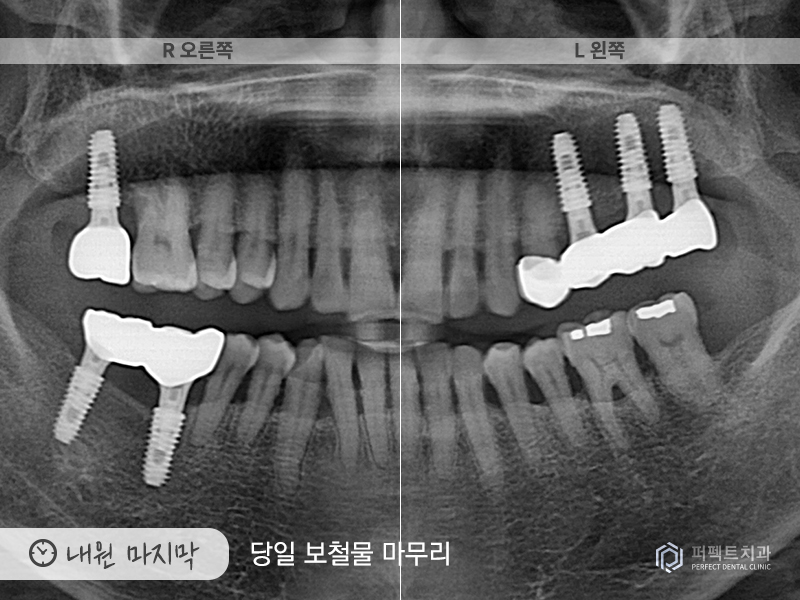 장거리+다수의 임플란트 케이스 관련 이미지 8