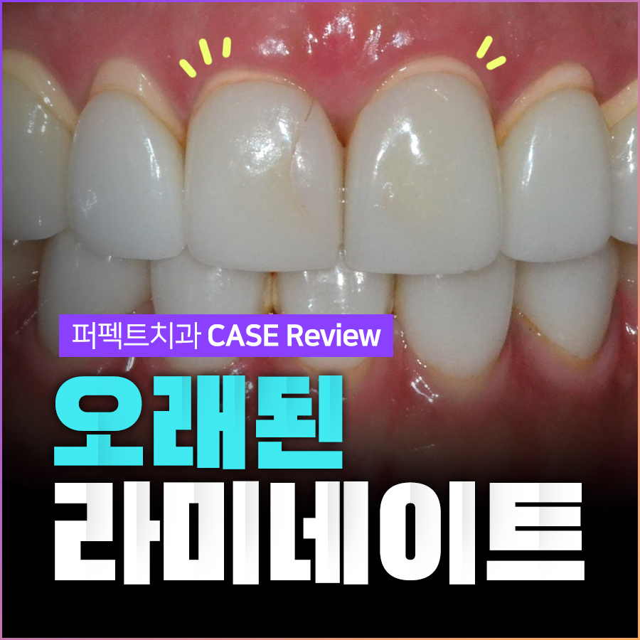 오래된 라미네이트 재시술, 보철물 교체 (잇몸노출,변색) 관련 이미지 1